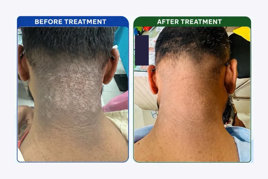 Supplied before-and-after graphic showing skin at the back of the neck.