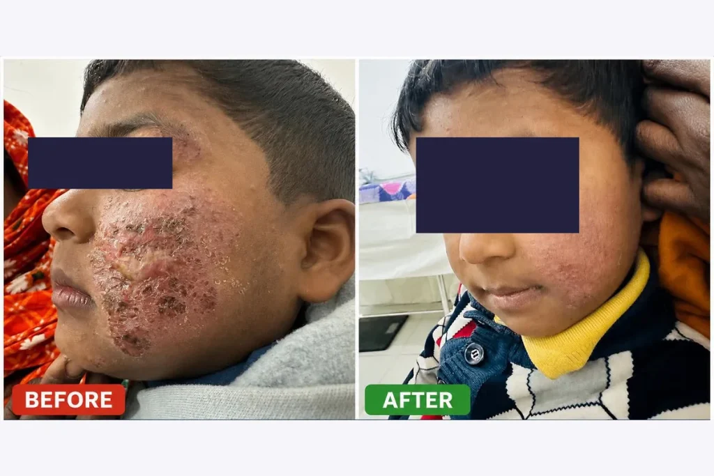 Supplied before-and-after graphic showing skin on a child’s cheek.