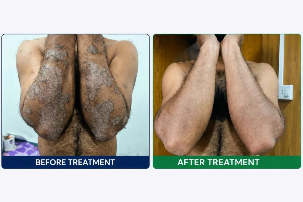 Supplied before-and-after graphic showing skin on the elbows.