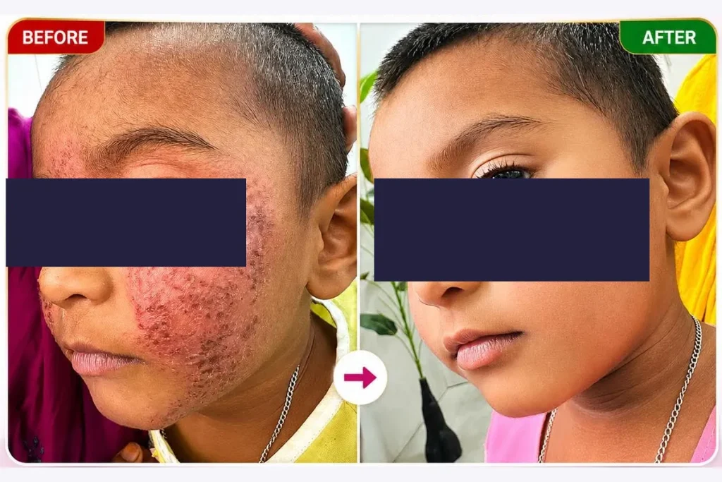 Supplied before-and-after graphic showing skin on a child’s face.